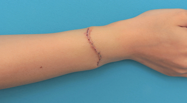 症例写真,根性焼きの傷跡を手術で切除縫合し1本の傷にした症例写真,手術直後,mainpic_wrist002i.jpg