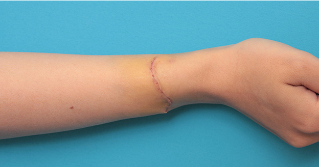 症例写真,根性焼きの傷跡を手術で切除縫合し1本の傷にした症例写真,1週間後,mainpic_wrist002j.jpg