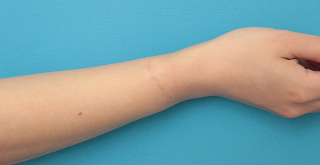 症例写真,根性焼きの傷跡を手術で切除縫合し1本の傷にした症例写真,6ヶ月後,mainpic_wrist002m.jpg