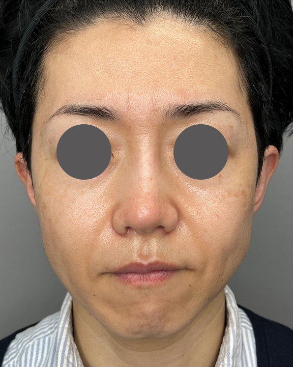 症例写真,バッカルファット切除で頬のふくらみを改善させた症例写真,After（1ヶ月後）,ba_buccalfat023_b01.jpg