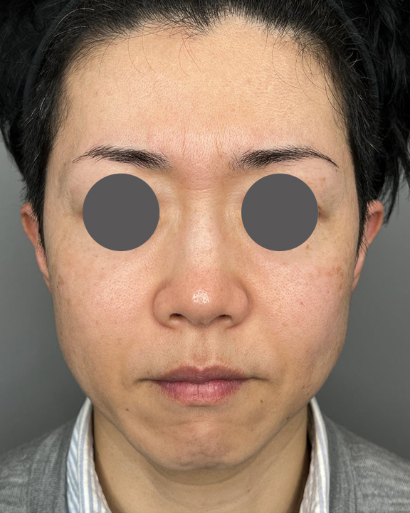 症例写真,バッカルファット切除で頬のふくらみを改善させた症例写真,Before,ba_buccalfat023_b01.jpg