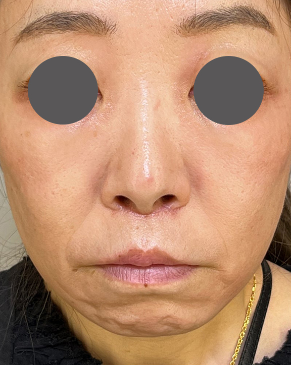 鼻の下の余分な皮膚を切除する人中短縮術を行った症例写真,After（抜糸後）,ba_hanashita010_a01.jpg