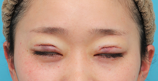 症例写真,二重まぶたミニ切開法で幅広平行型二重を作った20代女性の症例写真,手術直後,mainpic_mini_sekkai45d.jpg