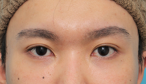 症例写真,目頭切開+二重まぶた埋没法2針固定を行った20代男性の症例写真,After(目を開けた状態)<br/>
(6ヶ月後),ba_megashira064_b01.jpg