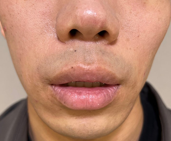 症例写真,上下口唇縮小術を行って唇をスッキリとさせた男性の症例写真,Before,ba_usuku019_b01.jpg