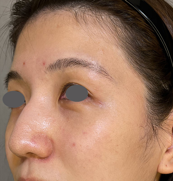 症例写真,鼻の骨切り幅寄せ＆ハンプ切除の症例写真,Before,ba_honekiri012_b02.jpg