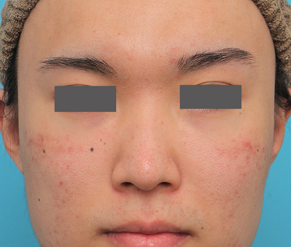 症例写真,小鼻縮小手術を行った20代男性の症例写真,Before,ba_biyoku054_b01.jpg
