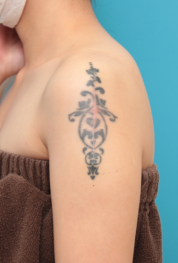 刺青（タトゥー）除去,肩の大きな入れ墨を2回に分けて切除縫縮した症例写真,1回目手術後6ヶ月,mainpic_irezumi038e.jpg