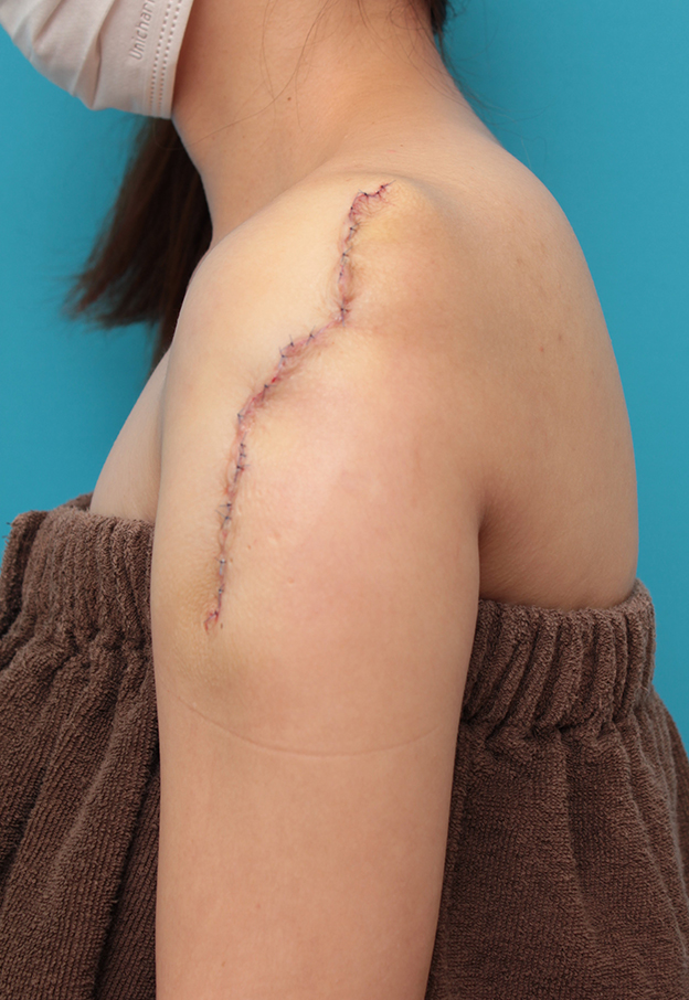 刺青（タトゥー）除去,肩の大きな入れ墨を2回に分けて切除縫縮した症例写真,2回目手術直後,mainpic_irezumi038f.jpg