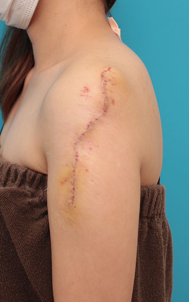 刺青（タトゥー）除去,肩の大きな入れ墨を2回に分けて切除縫縮した症例写真,2回目手術後1週間,mainpic_irezumi038g.jpg