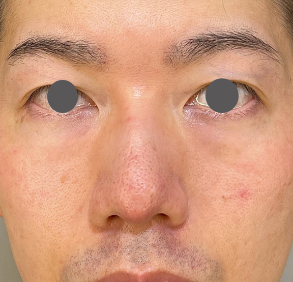 症例写真,耳介軟骨移植（クローズド法）で鼻を伸ばした症例写真,After（1ヶ月後）,ba_jikai049_b03.jpg