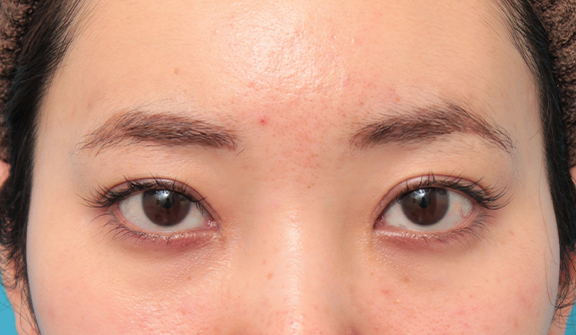 症例写真,眼瞼下垂手術でツリ目を改善し、目を大きくした20代女性の症例写真,After（6ヶ月後）,ba_ganken045_b01.jpg