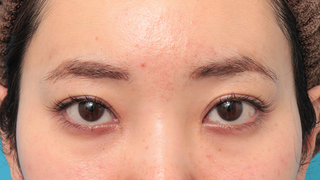 症例写真,眼瞼下垂手術でツリ目を改善し、目を大きくした20代女性の症例写真,6ヶ月後,mainpic_ganken045f.jpg