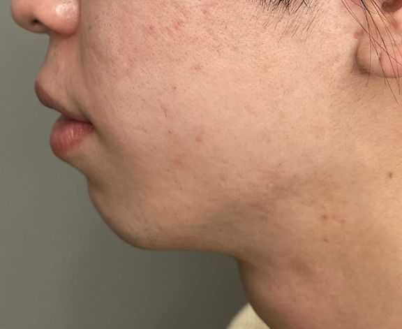 症例写真,口唇縮小術で上下の唇を薄くした20代男性の症例写真,Before,ba_usuku020_b02.jpg
