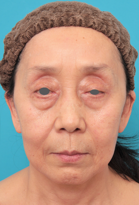 ミディアムフェイスリフトを行った60代女性の症例写真,Before,ba_mediumlift023_b01.jpg