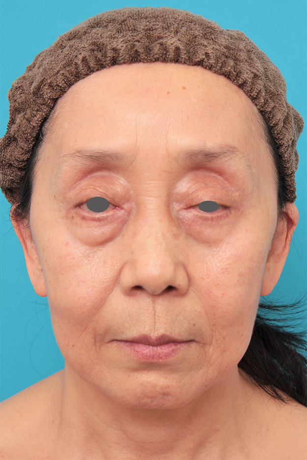 ミディアムフェイスリフト,ミディアムフェイスリフトを行った60代女性の症例写真,手術前,mainpic_mediumlift023a.jpg