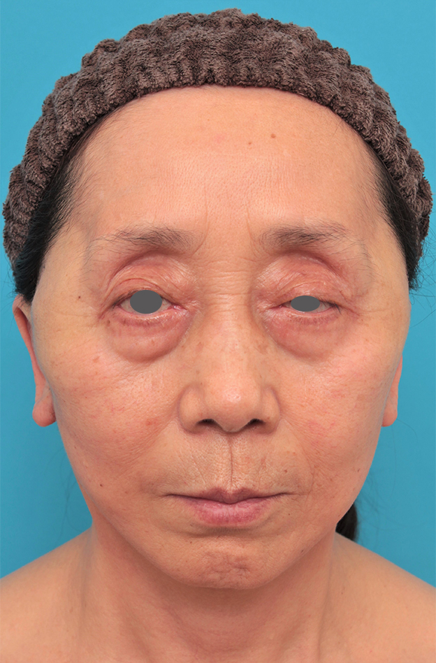 ミディアムフェイスリフト,ミディアムフェイスリフトを行った60代女性の症例写真,手術直後,mainpic_mediumlift023b.jpg