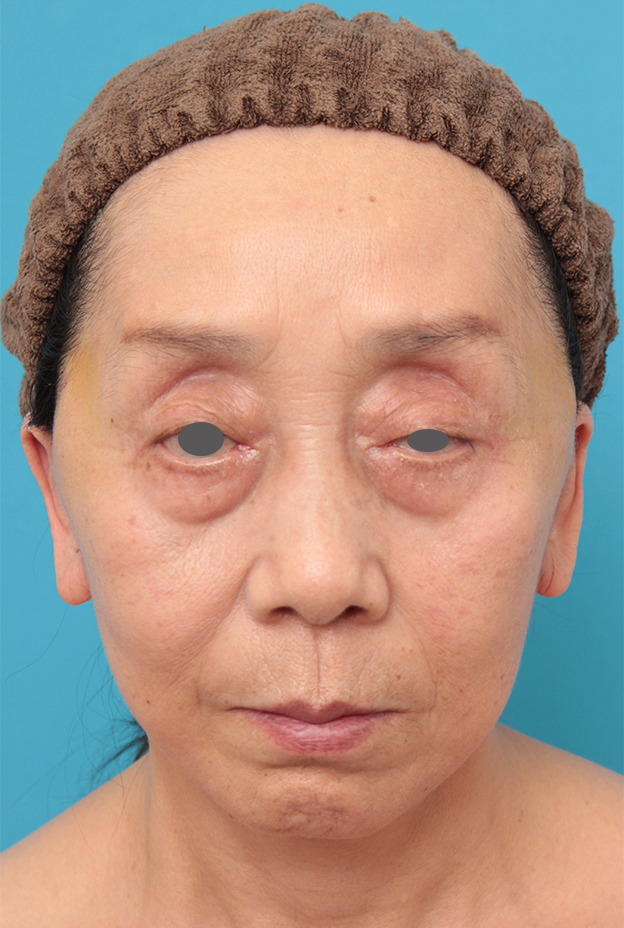 ミディアムフェイスリフト,ミディアムフェイスリフトを行った60代女性の症例写真,1週間後,mainpic_mediumlift023c.jpg