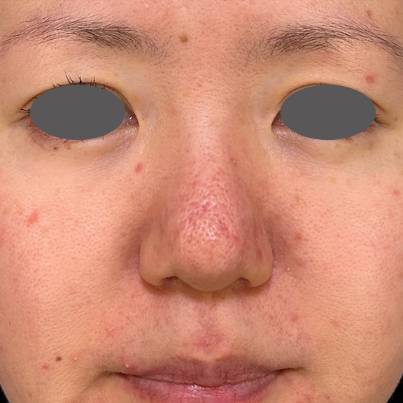 症例写真,外側法と内側法を組み合わせて施術した鼻翼縮小（小鼻縮小）の症例写真,After（1ヶ月後）,ba_biyoku055_b01.jpg