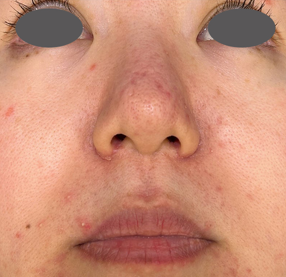 症例写真,外側法と内側法を組み合わせて施術した鼻翼縮小（小鼻縮小）の症例写真,After（1ヶ月後）,ba_biyoku055_b02.jpg