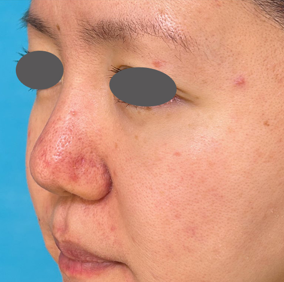 症例写真,外側法と内側法を組み合わせて施術した鼻翼縮小（小鼻縮小）の症例写真,After（1ヶ月後）,ba_biyoku055_b03.jpg