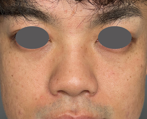 症例写真,鼻施術として、鼻翼縮小（小鼻縮小）のみを行った症例写真,After（1ヶ月後）,ba_biyoku056_b01.jpg