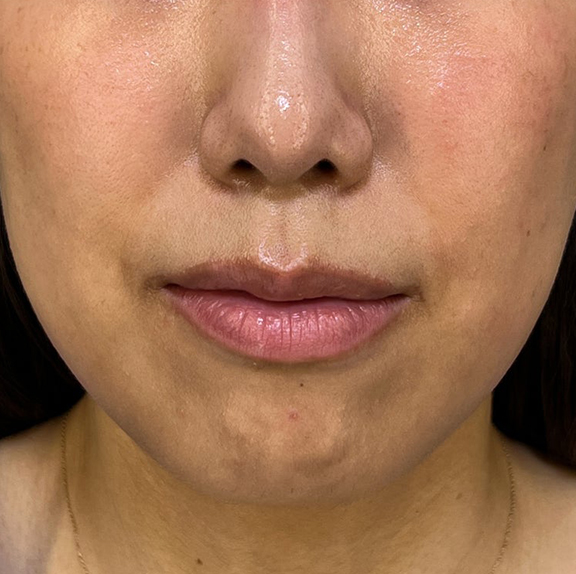 上下の唇を薄くした症例写真,After（1ヶ月後）（口を閉じた状態）,ba_usuku021_a01.jpg