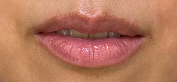 症例写真,上下の唇を薄くした症例写真,After（1ヶ月後）（口を開いた状態）,ba_usuku021_b02.jpg