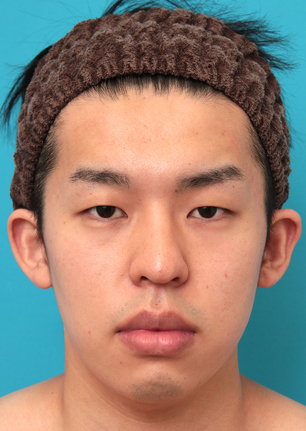 症例写真,眼瞼下垂手術で目を大きくして二重を作った20代男性の症例写真,手術前,mainpic_ganken047a.jpg
