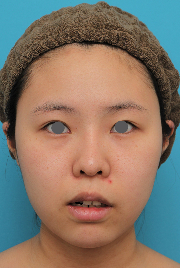 症例写真,顎シリコンプロテーゼ+下唇薄くする手術を行った20代女性の症例写真,手術前,mainpic_ago025b.jpg