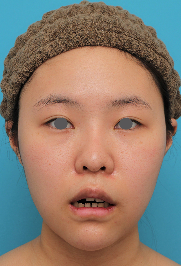 症例写真,顎シリコンプロテーゼ+下唇薄くする手術を行った20代女性の症例写真,10日後,mainpic_ago025e.jpg