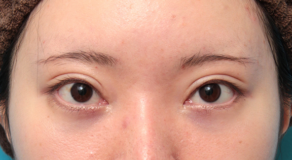 タレ目形成手術（グラマラスライン）と目の下脂肪取り（脱脂）を同時に行った20代女性の症例写真,After（4ヶ月後）,ba_panda024_a01.jpg