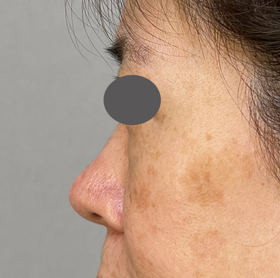 耳介軟骨移植（鼻先を出す）,耳介軟骨移植で鼻の丸みを修正した症例写真,After（3ヶ月後）,ba_jikai051_b02.jpg