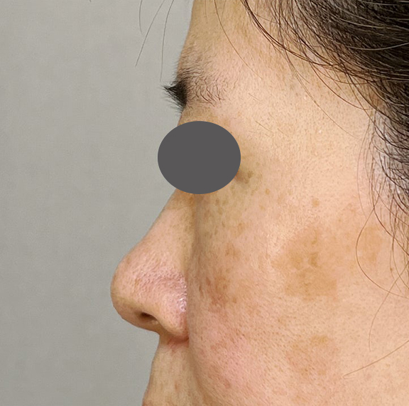 耳介軟骨移植（鼻先を出す）,耳介軟骨移植で鼻の丸みを修正した症例写真,Before,ba_jikai051_b02.jpg