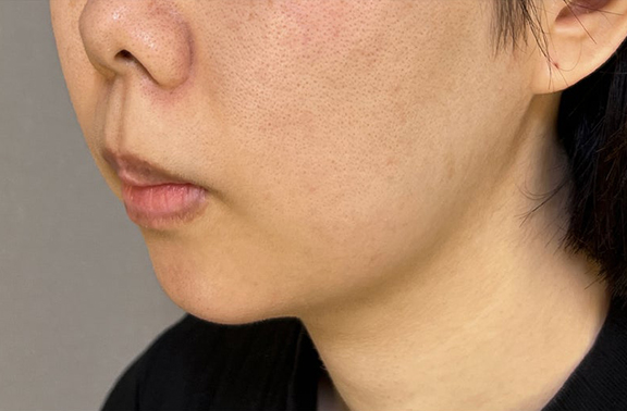症例写真,顎プロテーゼであごをシャープにした症例写真,After（3ヶ月後）,ba_ago026_b02.jpg