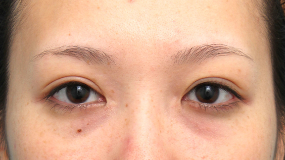 蒙古ひだ形成・目頭切開後の修正,他院で切られすぎた目頭切開を蒙古襞形成で戻した女性の症例写真,After（蒙古襞形成手術後5ヶ月）,ba_hida012_b01.jpg
