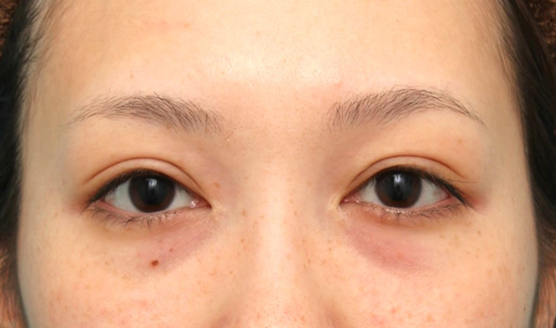 症例写真,他院で切られすぎた目頭切開を蒙古襞形成で戻した女性の症例写真,修正手術前,mainpic_hida012a.jpg