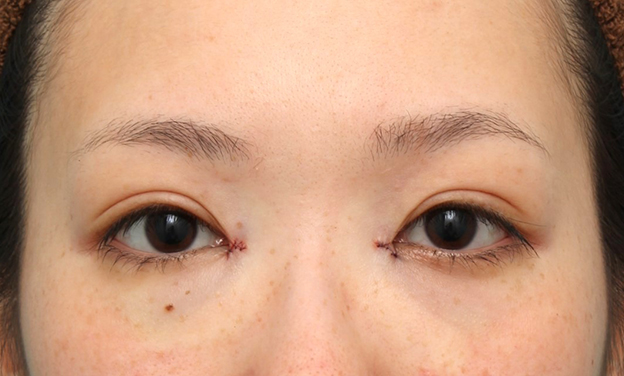 症例写真,他院で切られすぎた目頭切開を蒙古襞形成で戻した女性の症例写真,蒙古襞形成手術直後,mainpic_hida012b.jpg