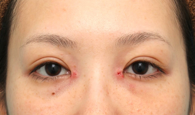症例写真,他院で切られすぎた目頭切開を蒙古襞形成で戻した女性の症例写真,1週間後,mainpic_hida012c.jpg