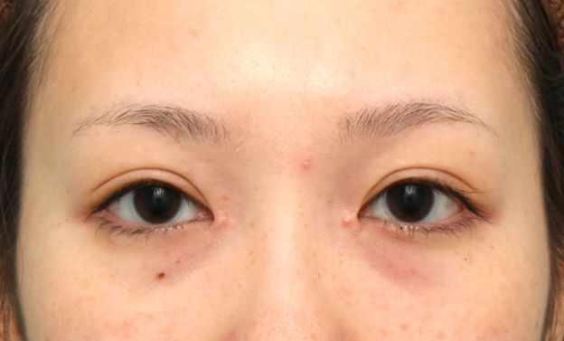 蒙古ひだ形成・目頭切開後の修正,他院で切られすぎた目頭切開を蒙古襞形成で戻した女性の症例写真,3週間後,mainpic_hida012d.jpg
