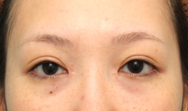 症例写真,他院で切られすぎた目頭切開を蒙古襞形成で戻した女性の症例写真,2ヶ月後,mainpic_hida012e.jpg