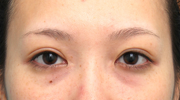 症例写真,他院で切られすぎた目頭切開を蒙古襞形成で戻した女性の症例写真,5ヶ月後,mainpic_hida012f.jpg