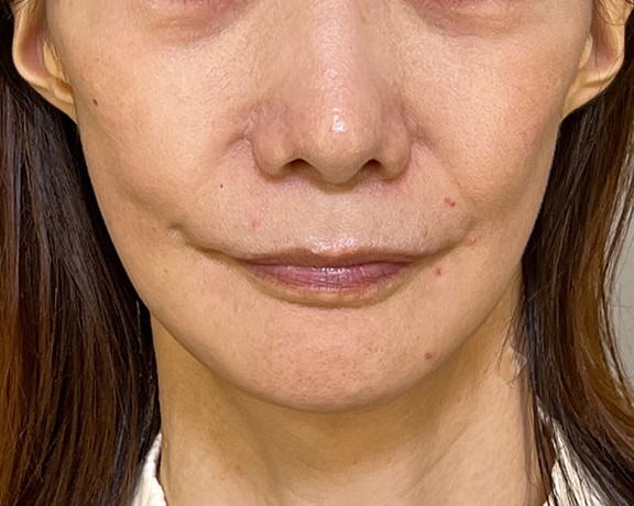 ミニフェイスリフトで頬のたるみを改善した症例写真,After（3ヶ月後）,ba_minilift018_a01.jpg