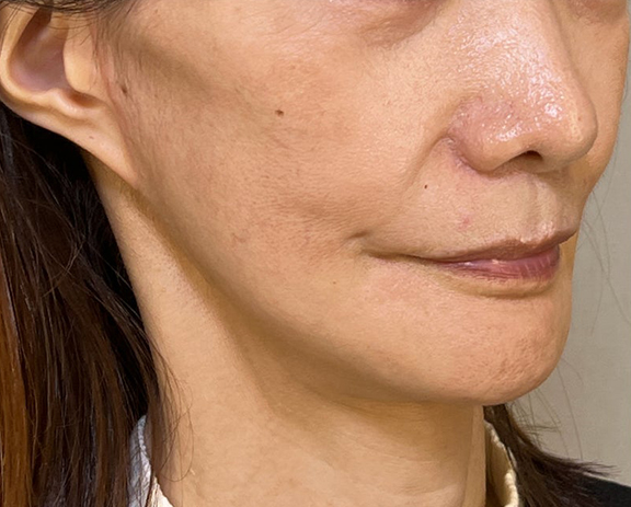 症例写真,ミニフェイスリフトで頬のたるみを改善した症例写真,After（3ヶ月後）,ba_minilift018_b02.jpg