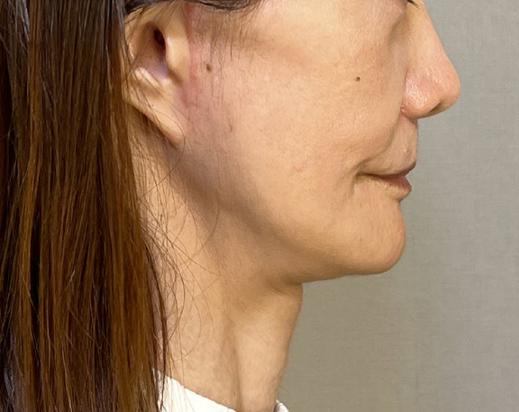 症例写真,ミニフェイスリフトで頬のたるみを改善した症例写真,After（3ヶ月後）,ba_minilift018_b03.jpg