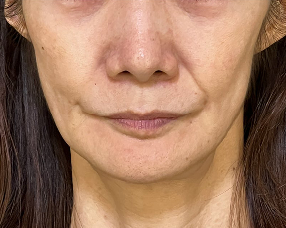 ミニフェイスリフトで頬のたるみを改善した症例写真,Before,ba_minilift018_b01.jpg