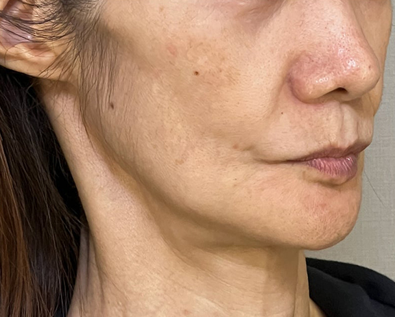 ミニフェイスリフト（頬のたるみ取り）,ミニフェイスリフトで頬のたるみを改善した症例写真,Before,ba_minilift018_b02.jpg