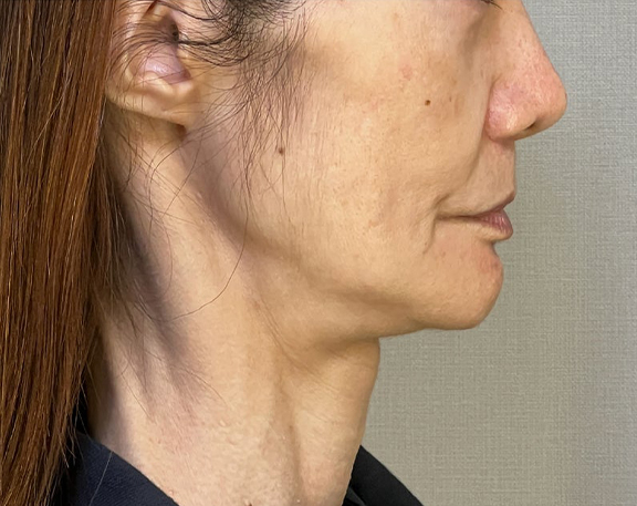 ミニフェイスリフト（頬のたるみ取り）,ミニフェイスリフトで頬のたるみを改善した症例写真,Before,ba_minilift018_b03.jpg