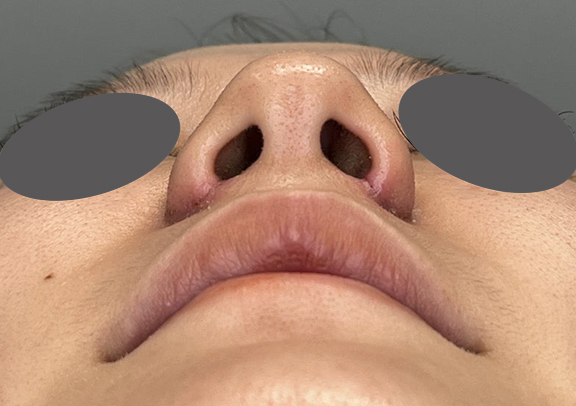 鼻翼縮小（小鼻縮小）,鼻翼縮小で小鼻の横への張り出しを改善した症例写真,After術後5日目（抜糸直後）,ba_biyoku057_b02.jpg