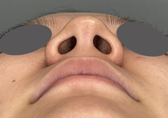症例写真,鼻翼縮小で小鼻の横への張り出しを改善した症例写真,Before,ba_biyoku057_b02.jpg